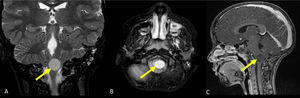 Resonancia magnética con contraste que muestra un glioma pontinomedular de bajo grado en el lado izquierdo (flecha) afectando al núcleo sensorial del nervio trigémino, sin y con contraste con gadolinio (caso 2). A: coronal T2; B: Axial T2-FLAIR; C: sagital T1 post-gadolinio.