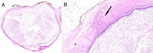 Dos secciones teñidas con hematoxilina-eosina, mostrando una lesión quística rellena de escamas anucleadas de queratina (A, aumento 2,5x), en la pared del quiste presenta una unidad pilosebácea (flecha) (B, aumento 15x).