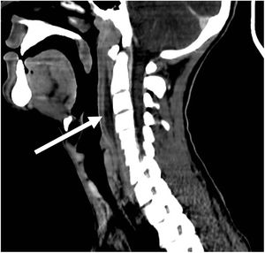 Colección laminar de 7,5×3,3×0,9cm en espacio retrofaríngeo que se extiende desde C2 a C6.