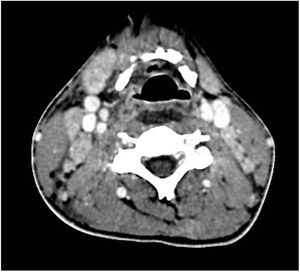 Adenopatías laterocervicales bilaterales de aspecto reactivo.