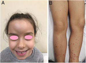 A) Edema frontal local en el ingreso inicial. B) Exantema purpúrico típico en ambas extremidades inferiores.