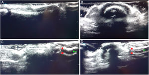 Comparativa ecográfica entre imágenes de los dos primeros dedos de los pies. Observamos cortes longitudinal A) y transversal B) de la uña sana respecto a proyecciones longitudinal C) y transversal D) de la uña afecta de retroniquia. Vemos la imagen característica de retroniquia con dos láminas ungueales superpuestas (*) y un espacio hipoecoico entre ellas (flecha).