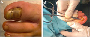 Aspecto preoperatorio de la uña afecta A). Se observa elevación de la uña a nivel proximal con eritema periungueal. En la imagen B) vemos el tratamiento quirúrgico de onicoexéresis con abordaje proximal.