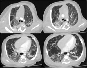 TC torácica. Infiltrado pulmonar bilateral en vidrio deslustrado, áreas consolidativas compatibles con atelectasias y engrosamiento septal interlobulillar liso de predominio.