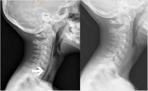 Izquierda: Radiografía lateral cervical donde se observa la presencia de aire ectópico en el espacio retrofaríngeo (cabeza de flecha blanca). Derecha: Radiografía lateral cervical realizada 15días después, con resolución prácticamente completa de los hallazgos.