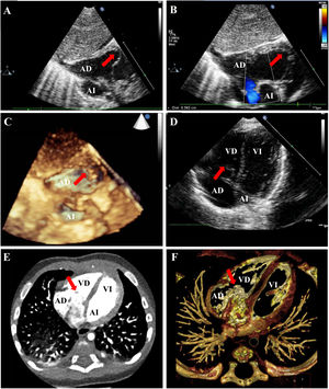 A. Eje subcostal ecocardiografía paciente 1. B. Eje subcostal ecocardiografía paciente 1. Flujo derecha-izquierda a través del foramen oval permeable (flujo azul). C. Eje subcostal ecocardiografía 3D paciente 1. D. Eje cuatro cámaras ecocardiografía paciente 1. E-F. Angio-TC del paciente 4. AD: aurícula derecha; AI: aurícula izquierda; VD: ventrículo derecho; VI: ventrículo izquierdo; TC: tomografía computarizada; Flecha roja: red de Chiari.