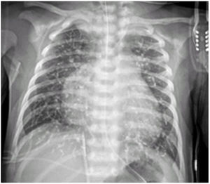 Cardiomegalia, atrapamiento aéreo, opacidad de la vascularización pulmonar sin afectación parenquimatosa. Portador de sonda orogástrica y catéter femoral.