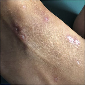 Imagen de dorso del pie donde se visualizan pápulas de 0,5-1cm con centro atrófico nacarado y borde eritematoso telangiectásico.