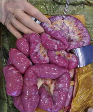 Imagen intraoperatoria macroscópica de intestino delgado donde se visualizan placas blanquecinas y atróficas con lesiones necróticas en todo el íleon, peritoneo y apéndice. También se aprecia una perforación (señalado con pinzas en parte superior) en íleon distal.