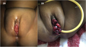 La imagen A muestra una lesión polipoidea, de 2 semanas de evolución. La imagen B muestra la misma tumoración 2 meses después. Se caracteriza por numerosas lesiones tuberosas-polipoideas de color rojo oscuro y con apariencia en «racimo de uvas» que ocupan la mucosa vulvar y protruyen a través del introito vaginal.