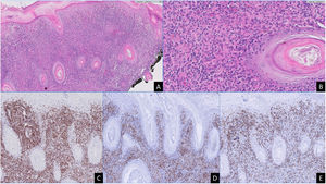Histopatología del desorden linfoproliferativo cutáneo de células T CD4+ de pequeño/mediano tamaño. A) Infiltrado linfocitario denso en dermis superficial y profunda (HE x100). B) A mayor aumento, linfocitos con moderada atipia en área perifolicular (HE x400). El infiltrado linfoide es positivo para los marcadores CD3 (C) y CD4 (D), con una población minoritaria acompañante de linfocitos CD8 (E). (C-E: x400).