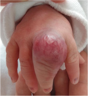 Hemangioma congénito al nacimiento.