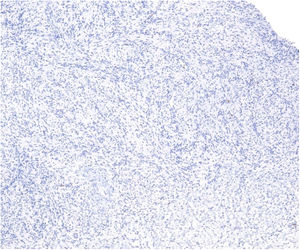 Histología: Tinción GLUT-1 negativa.