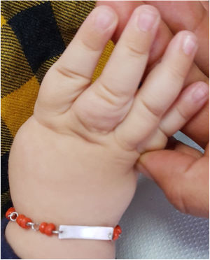 Involución de hemangioma congénito a los 9 meses.