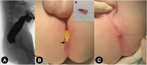 Colostograma que muestra el bolsón rectal sin fístula, probablemente debido a una presión insuficiente durante su realización (A). Colgajo de piel digitiforme resecado (*) y aparición de una gota de líquido bajo su ubicación original tras la irrigación del estoma distal (flecha) (B). El poro fue intubado mediante un balón de dilatación (C).