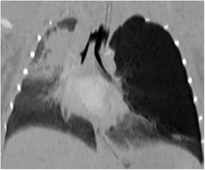 Proyección de mínima intensidad en el plano coronal. Hiperclaridad con efecto masa en el lóbulo superior izquierdo con desplazamiento contralateral del mediastino. Atelectasia del lóbulo superior derecho.