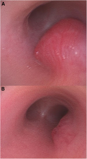 Imágenes bronscoscópicas de la lesión. A: imagen diagnóstica. B: imagen tras 5 meses de tratamiento con propranolol oral. Nótese la marcada reducción del tamaño de la lesión.