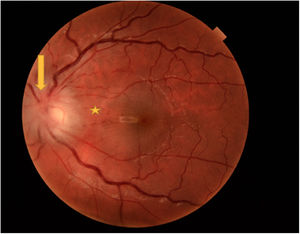 Edema de papila y edema de retina peripapilar en el ojo izquierdo (flecha); pequeñas hemorragias puntiformes en haz papilomacular (asterisco); ingurgitación árbol vascular.