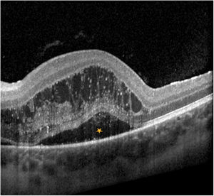 OCT macular del ojo izquierdo donde se aprecia el edema macular (asterisco).