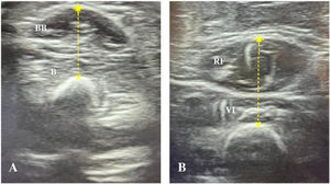 Evaluación ecográfica del grosor muscular del bíceps braquial/braquial y cuádriceps femoral. Corte transversal obtenido con sonda lineal. A) Bíceps braquial/braquial. BB: bíceps braquial; b: braquial. B) Cuádriceps femoral. RF: recto femoral; VI: vasto intermedio.