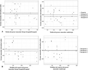 Gráficos de Bland-Altman para los examinadores inexpertos y el experto. A) Análisis Bland-Altman intraobservador de las diferencias entre las mediciones repetidas (cm) y la media del grosor muscular (cm). B) Análisis Bland-Altman interobservador de las diferencias entre las medidas repetidas (cm) y las medidas del experto del grosor muscular (cm).
