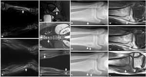(A y B) Niño de 2 años que presentó dolor y signos de inflamación local en la extremidad inferior derecha con elevación leve de la VSG (34mm/h) y la PCR (4mg/L). (A) La RM inicial reveló edema metafisario y diafisario en la tibia derecha (flecha). No se aisló ningún patógeno y la enfermedad se clasificó como osteomielitis bacteriana sin etiología microbiológica identificada. (B) A los 5 meses, tuvo un episodio similar en la extremidad inferior izquierda, y la RM reveló edema metafisario y diafisario en la tibia izquierda (flecha), llevando al diagnóstico de OMCR. (C-E) Niña de 11 años que presentó dolor y signos de inflamación local en la extremidad inferior derecha con elevación leve de la VSG (24mm/h) y la PCR (3mg/L). Antecedente de dolor de espalda de un año de duración. La RMCE en secuencia STIR (short tau inversion recovery) reveló múltiples focos de edema óseo: en la metáfisis tibial (flechas en C), en el cuerpo vertebral de T7 (flecha en D), y la pared posterior del acetábulo (flecha en E). (F-K) Adolescente varón de 14 años que presentó dolor y signos de inflamación local en la extremidad inferior izquierda y elevación leve de la VSG (80mm/h) y la PCR (3mg/L). (F) La radiografía anteroposterior inicial mostró una lesión lítica excéntrica adyacente a la fisis al nivel de la metáfisis de la tibia distal (flecha), con reacción perióstica discontinua (cabeza de flecha). (G) Cinco meses después, el tamaño de la lesión había disminuido (flecha) y la reacción perióstica era continua (cabeza de flecha). (H) A los 2 años, la lesión se había resuelto, con esclerosis ósea residual mínima (flecha). (I) RM al diagnóstico con visualización de una lesión transfisaria: hipointensa en secuencias T1 (flecha) e (J) hiperintensa en secuencias T2 (flecha). (K) Realce intenso de la lesión ósea y los tejidos blandos circundantes (flecha).