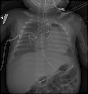 Radiografía a los 2 meses y medio de vida. Es la primera radiografía realizada a la paciente en la que ya se observa engrosamiento cortical, que es más evidente en las diáfisis de ambos húmeros (flecha), observándose la forma original de los huesos. También se observa engrosamiento de otros huesos como costillas, clavículas y escápulas.