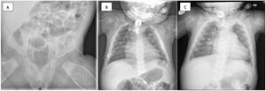 Radiografías después del trasplante y del fin de tratamiento con prostaglandinas. A) A los 3 meses, B) a los 4 meses, C) a los 6 meses. En ellas se sigue observando hiperostosis y ensanchamiento de los huesos, sin mejoría ni resolución tras el cese de las prostaglandinas. Las vértebras y pelvis no parecen estar afectadas. Tampoco se observa afectación mandibular.