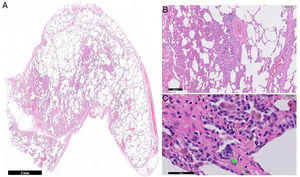 Cortes histológicos de la biopsia pulmonar de LID (imágenes A, B y C). La imagen A (x0,5) muestra una vista panorámica de corte de cuña pulmonar con alteración parcial de la arquitectura habitual con presencia de estructuras nodulares. El parénquima pulmonar presenta un infiltrado inflamatorio linfoplasmocitario e histiocitario localizado en eje bronquiolovascular y descamación de macrófagos en los espacios alveolares (B y C). La flecha señala un agregado de células histiocitarias compatible con una célula gigante multinucleada (C).