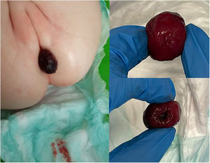 Izquierda: fotografía clínica de la paciente. Lesión mucosa violácea que prolapsa a través del ano. Nótese la presencia de sangre fresca en el pañal. Derecha: tumoración mucosa con base ulcerada que la paciente expulsó espontáneamente a través del ano.