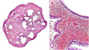 Estudio histológico de la lesión (hematoxilina & eosina, microfotografías). Izquierda (2×): corte transversal del pólipo. Se observa dilatación glandular acompañada de espacios quísticos en la lámina propia. Derecha (10×): revestimiento glandular por epitelio de células cubicas acompañadas de células caliciformes. Congestión vascular, infiltrado linfoplasmocitario y marcada eosinofilia.