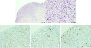 a) Tinción de hematoxilina-eosina (H&E) (×40). La biopsia mostró un pequeño infiltrado celular subepidérmico que se extendía a la dermis papilar y bordeado de un collarete epidérmico. b) Tinción H&E (×400). Células histiocíticas con núcleo eucromático, contornos irregulares y citoplasma microvesicular. Ligera fibrosis del estroma frecuentemente con presencia de eosinófilos. c) Tinción inmunohistoquímica de CD68 (×200). Células positivas para CD68. d) Tinción inmunohistoquímica de CD1a (×200). Células negativas para CD1a. e) Tinción inmunohistoquímica de S100 (×200). Células negativas para S100.