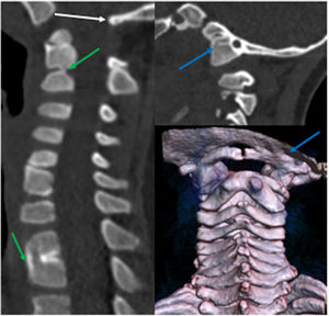 TAC cráneo-cervical: estenosis del agujero magno (flecha blanca), asimilación atlantooccipital derecha (flechas azules) y fusión parcial de varias vértebras (flechas verdes).