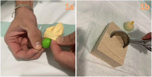 Construcción del modelo de pericardiocentesis guiada por ultrasonido de tofu. a)Llenar un globo pequeño (5cm de diámetro) con suero e introducirlo dentro de otro más grande (8cm de diámetro) que rellenaremos también de suero mediante jeringa de 50ml. b)Abrir un tofu firme y practicar un orificio con una cuchara de helado.