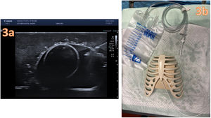 Construcción del modelo de pericardiocentesis guiada por ultrasonido de tofu. a)Pericardiocentesis guiada ecográficamente. a)Set de pericardiocentesis instalado completo.