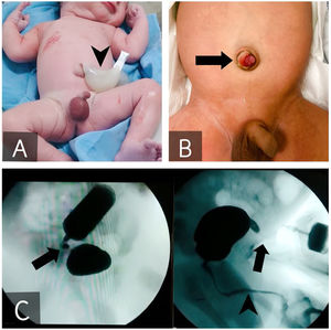 Cordón umbilical con gran quiste de 7×4,5cm (A, punta de flecha) y granuloma umbilical con secreción cetrina tras la caída del cordón (B, flecha). El fistulograma confirmó un uraco permeable (C, flecha) sin alteraciones uretrales (C, punta de flecha). Nótese en la parte superior y lateral de esta última imagen una estructura tubular radiolúcida que corresponde a la jeringa de inyección con contraste.