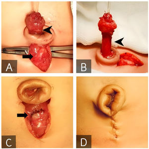 Incisión infraumbilical y disección uracal (A, punta de flecha) hasta la cúpula vesical (A, flecha). Escisión del trayecto de uraco permeable (B, punta de flecha), reparación de la cúpula vesical en 3 planos (C, flecha) y aspecto definitivo de la umbilicoplastia (D).