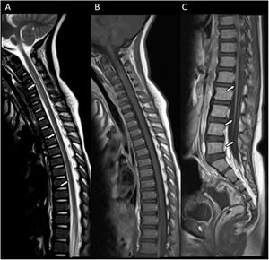 Afectación de las raíces de la cauda equina y la médula espinal, corte sagital. Hiperintensidad extensa en la espina dorsal anterior en secuencia T2, desde el segmento cervical al cono medular (flechas en A). Tras la administración de contraste, la imagen sagital en secuencia T1 mostró captación en las raíces ventrales de la cauda equina (flechas en C) sin captación en la mayoría de la médula espinal (B).