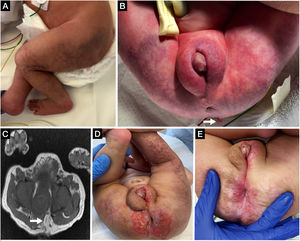 Hemangioma infantil segmentario en región perineal y lumbosacra con extensión a miembros inferiores (A) y apéndice cutáneo lumbosacro (B, flecha). Resonancia magnética que muestra un lipomielocele (C, flecha). Hemangioma perineal ulcerado (D), con buena respuesta terapéutica al propranolol (E).