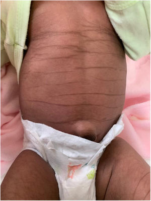 Líneas hiperpigmentadas generalizadas sobre los pliegues abdominales al mes de vida.