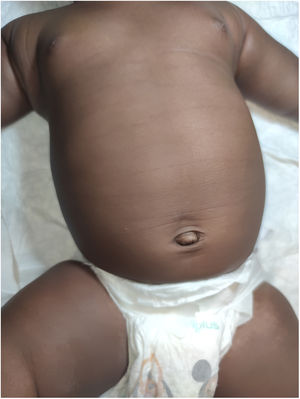 Líneas hiperpigmentadas abdominales en desaparición a los 4 meses de vida.