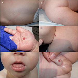 A-D y F) Imagen clínica. Pápulas eritematosas de aspecto congestivo de entre 2-6mm localizadas en la espalda, hombro derecho, palma derecha, clavicular derecho y pene. E) Imagen clínica de leve macroglosia.
