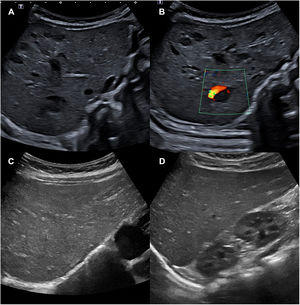 A y B) Ecografía abdominal en la que se visualizan entre 10 y 15 lesiones ocupantes de espacio hipoecogénicas compatibles con hemangiomas hepáticos. En la imagen B se aprecia señal doppler. C y D) Ecografía abdominal a los 4 meses de tratamiento, en la que han desaparecido los hemangiomas hepáticos. En la imagen no hay señal doppler.