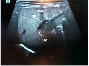 Imagen de canalización de la vena umbilical de forma ecoguiada. Se observa el catéter umbilical atravesando el seno portal hasta el conducto venoso. CVU: catéter venoso umbilical; DV: ductus venoso; SP: seno portal; VU: vena umbilical.