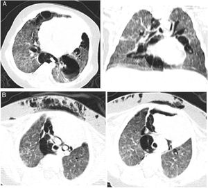 A. La tomografía computarizada en cortes axiales y coronales muestra infiltrados pulmonares intersticiales difusos y bilaterales y quistes subpleurales de paredes delgadas. B. Neumomediastino y enfisema subcutáneo.