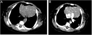 Corte axial de tomografía computarizada de tórax sin inyección de medio de contraste (A) y con medio de contraste (B) que evidenció hipertrofia del timo. Obsérvense las múltiples calcificaciones punteadas en el timo, que son características del compromiso de las células de Langerhans.