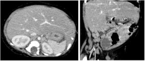 La tomografía computarizada de abdomen axial y coronal con contraste muestra hepatomegalia homogénea.