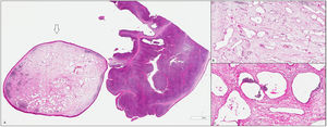 Microscopía. A) Amígdala derecha con hiperplasia reactiva de folículos linfoides con formación polipoide tapizada por epitelio escamoso y, en su porción central, numerosas estructuras vasculares de tipo linfático con contenido proteináceo y linfocitos. No se observan atipias. H&E, 10x magnificación original. B y C) Malformación vascular de tipo linfático. H&E, 20x y 40x magnificación original (B) y (C).