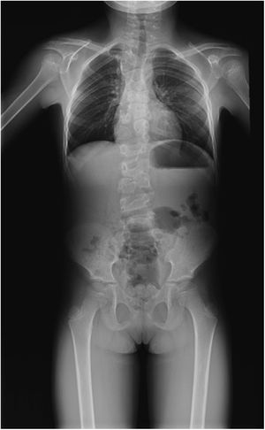 Radiografía de columna total (7 años y 7 meses): múltiples malformaciones vertebrales y costales. Escoliosis dorsal alta de convexidad derecha leve.