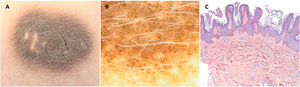 A. Placa ovalada, aterciopelada, de color marrón oscuro, en espalda. B. La dermatoscopia reveló estructuras ovoides marrones sobre un fondo claro (sistema de epiluminiscencia digital FotoFinder - Medicam 800 HD). C. Hiperqueratosis ortoqueratósica con acantosis, papilomatosis e hiperpigmentación de la capa basal (H-E, x40).